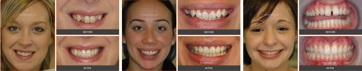 before and after cfast braces before and after cfast braces
