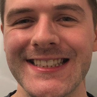 ClearCorrect teeth straightening results after